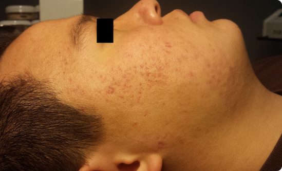 Before and after results of Celluma LED Therapy showing reduced acne after 8 weeks of twice-weekly treatments.