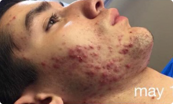 5-Week Acne Improvement with Celluma LED Therapy Significant improvement in acne visible after 5 weeks of Celluma LED light therapy sessions, done twice per week.