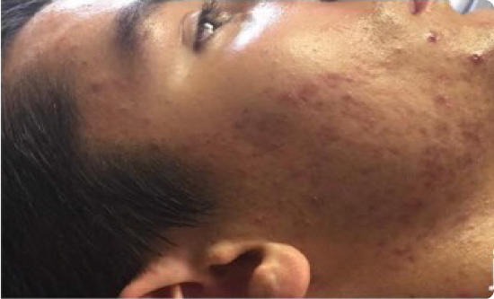 Significant improvement in acne visible after 5 weeks of Celluma LED light therapy sessions, done twice per week.