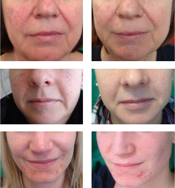 Before-and-after results of ultrasound skin treatment at Facials & Skincare by Debbie in Orange, CA, showcasing smoother, clearer, and rejuvenated skin.