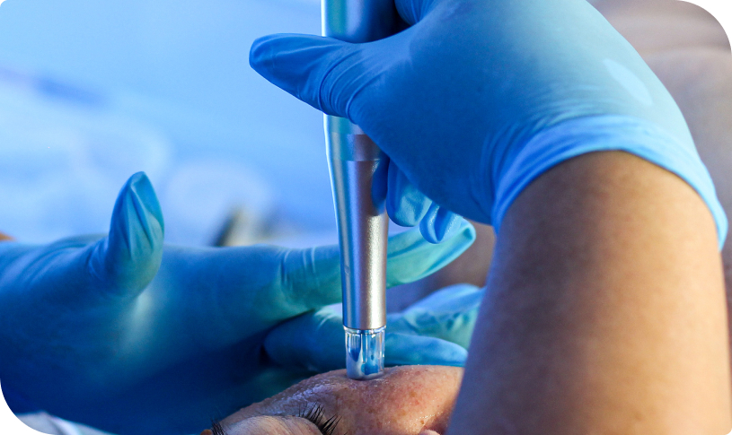 Close-up of the Rezenerate wand during a nano-infusion session, enhancing skin hydration and health.