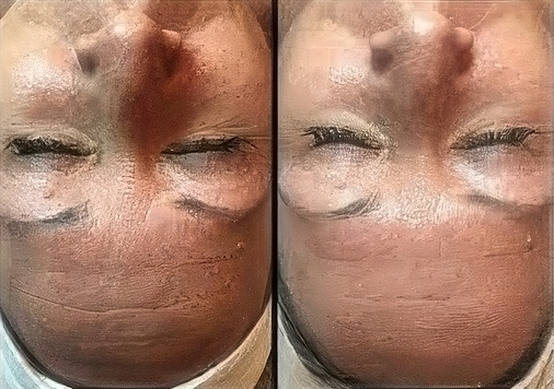 Before-and-after results of a nano-infusion facial, showing smoother and brighter skin. Ideal for clients in Villa Park and Santa Ana.